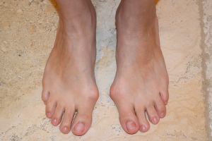 Pre-surgery feet